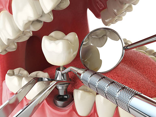 Best Emergency Tooth Extraction in Lake Wylie, SC